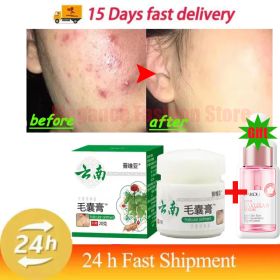 Body Acne Removal Cream Treatment Face Butt Back Acne Marks Smooth Repair Chicken Skin Cream Moisturizing Whitening Skin Care (Color: 1PC)